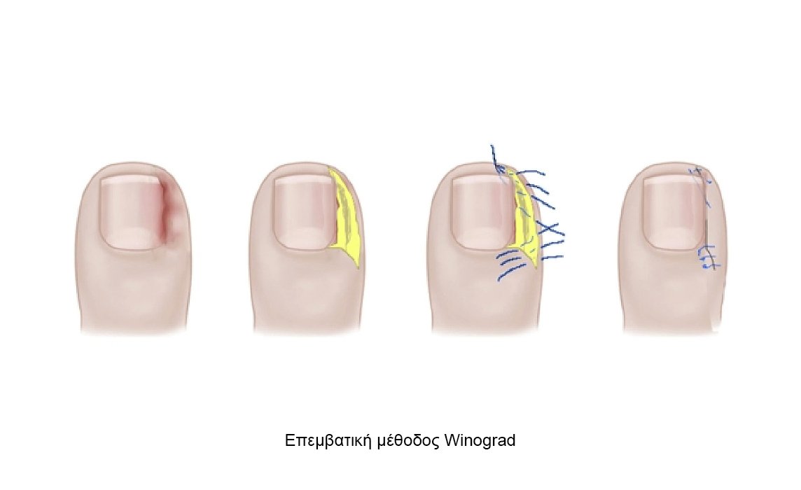 Επεμβατική μέθοδος από χειρουργούς